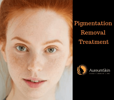 pigmentation removal treatment