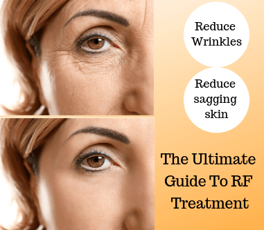 Cabina carrera limpiar Radiofrequency Skin Tightening: The Ultimate Guide To RF Treatment | Aureum  Skin
